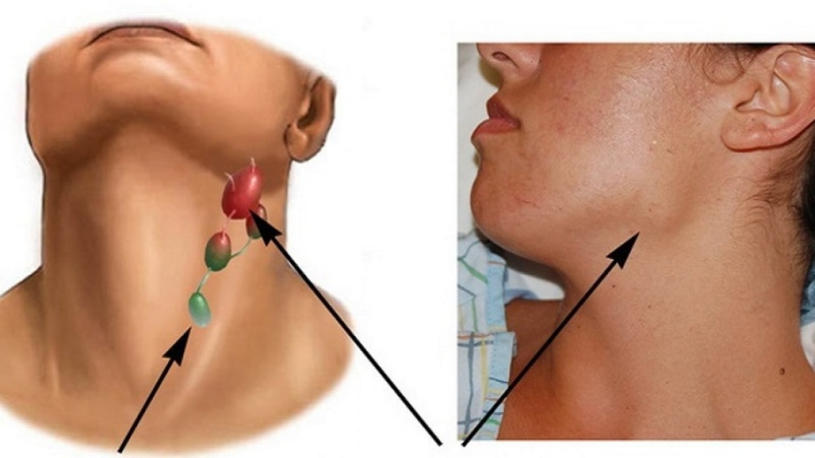 Chữa hạch cổ bằng thuốc nam