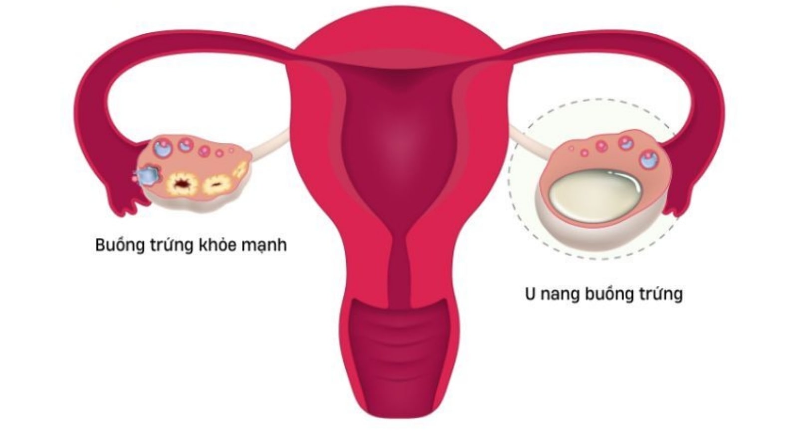 u nang buồng trứng có nguy hiểm không​