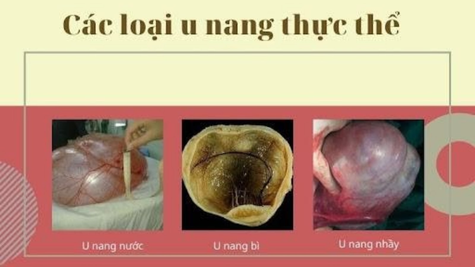 u nang buồng trứng có nguy hiểm không​