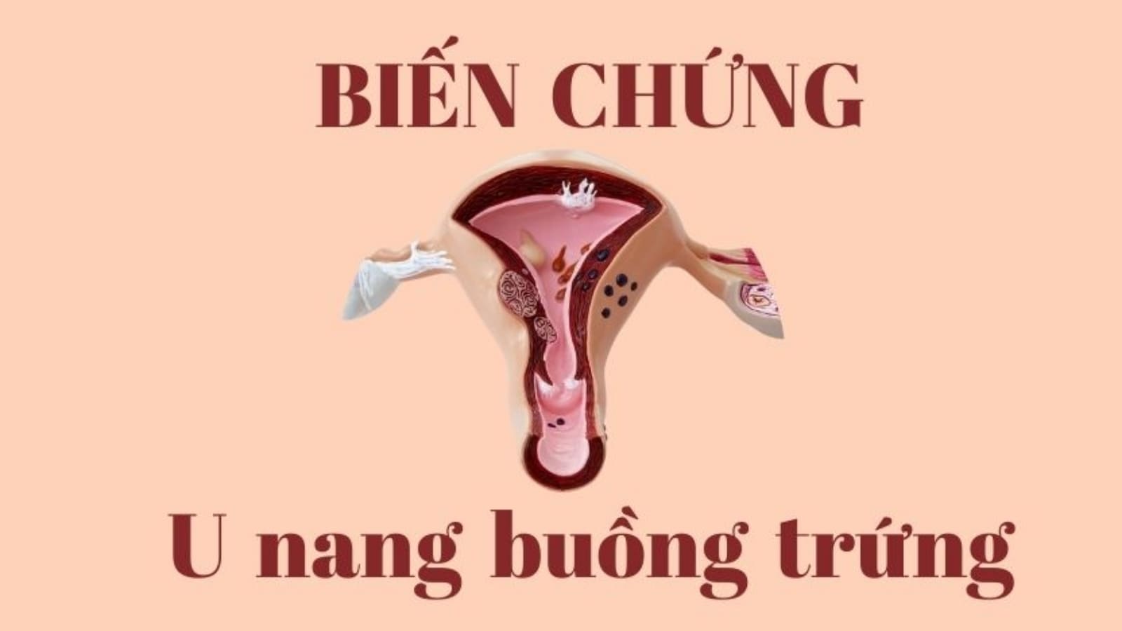 u nang buồng trứng có nguy hiểm không​