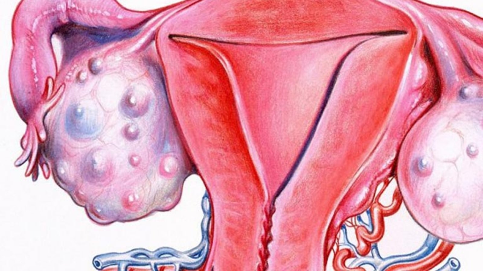 u nang buồng trứng có nguy hiểm không​